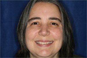 Las Vegas Cosmetic Dentistry Restoring a Fractured Tooth Las Vegas Cosmetic Dentistry Restoring a Fractured Tooth